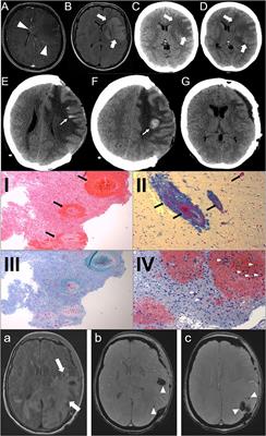 Case Report: Minimal Neurological Deficit of Two Adult Patients With Weston–Hurst Syndrome Due to Early Craniectomy: Case Series and Review of Literature on Craniectomy